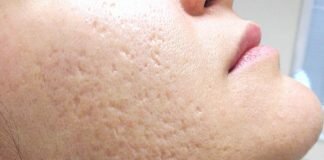 Clogged skin pores